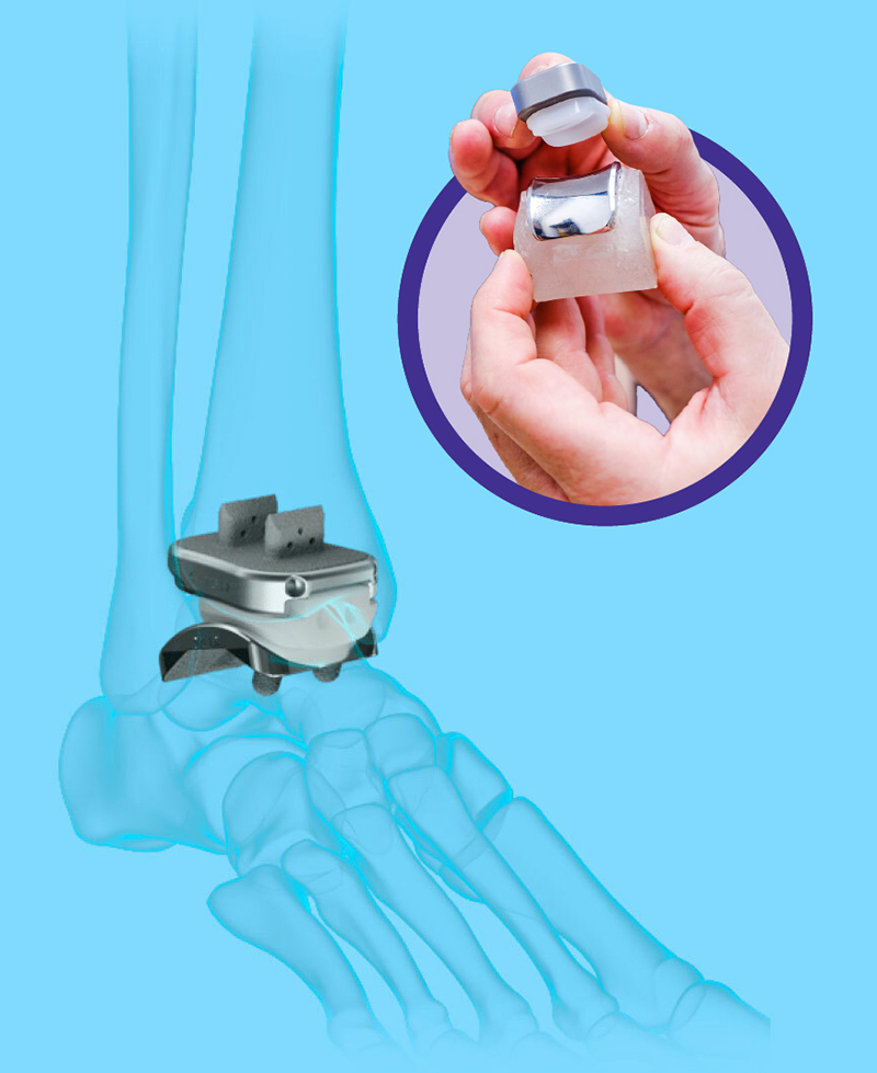 An image of an artificial ankle joint replacement overlaid on an illustration of the bones of a human foot