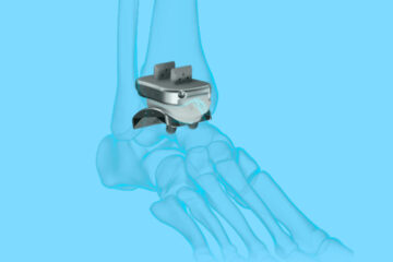 An image of an artificial ankle joint replacement overlaid on an illustration of the bones of a human foot