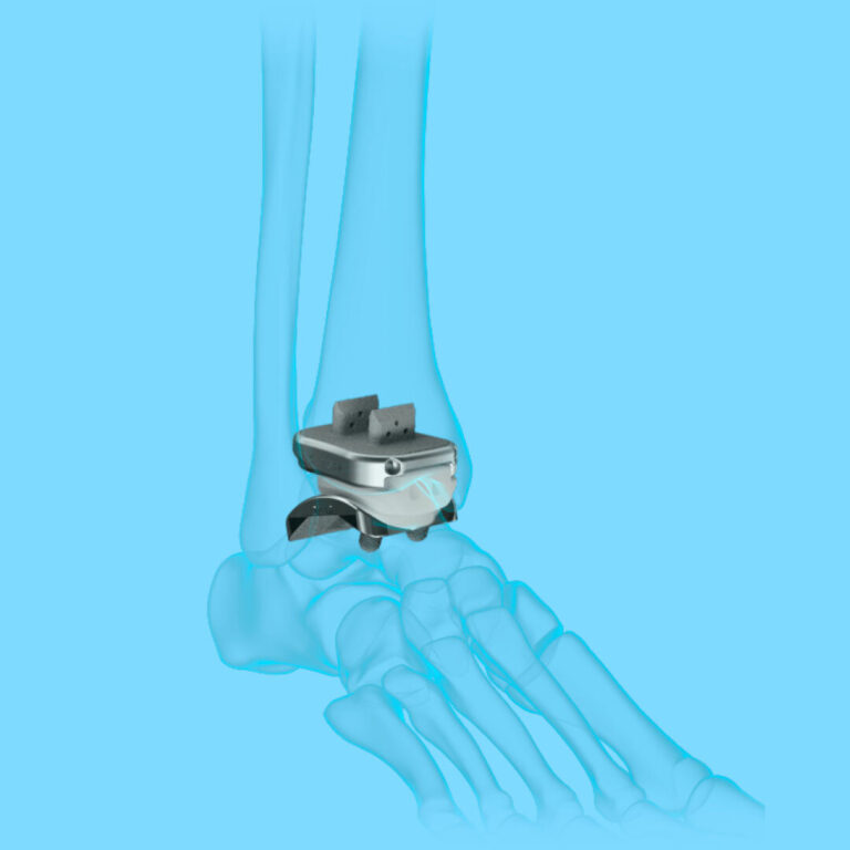 An image of an artificial ankle joint replacement overlaid on an illustration of the bones of a human foot